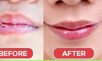 How to treat your dried lips during Winter Season? 